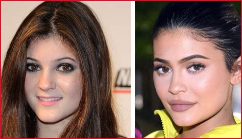 Kylie Jenner posts pic after getting all her lip filler removed